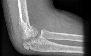 All Complex & Neglected Fracture and Deformity Correction